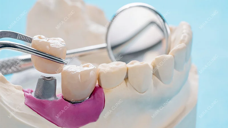 Dental Crown